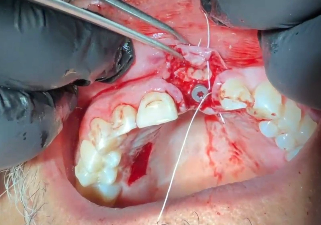 Caso 4 - Cirugía de Implantes - Dra. Ivanova Guerrero CDMX